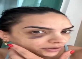 Natinha Do Vôlei Sofre Com Harmonização Malsucedida "Dor excruciante". Confira!